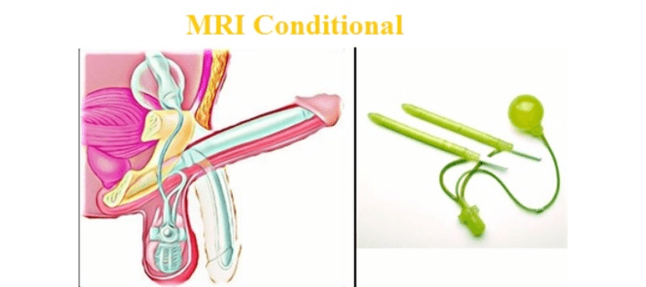 Chirurgické zvětšení penisu pomocí implantátu