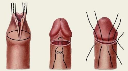 Jak se provádí plastická chirurgie penisu